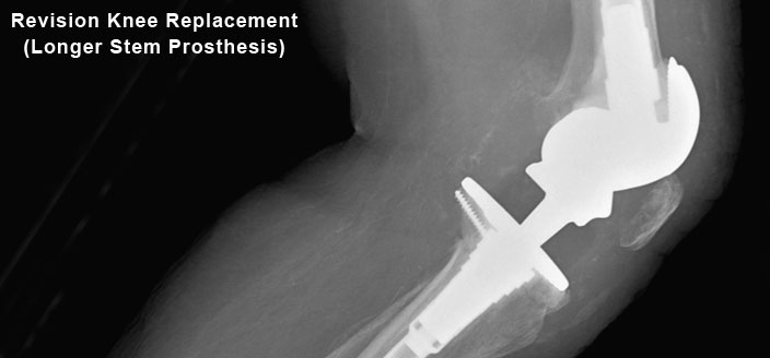 Revision Knee Replacement Prosthesis