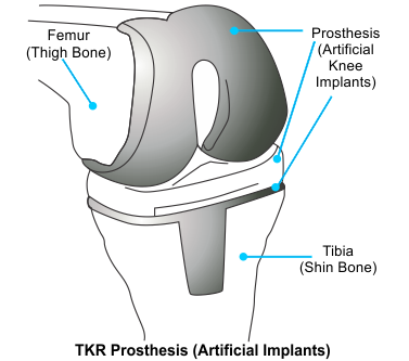 TKR Prosthesis