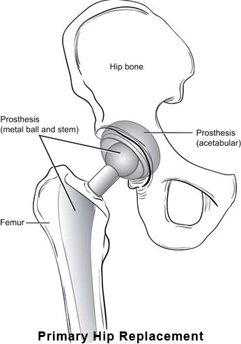 THR Prosthesis