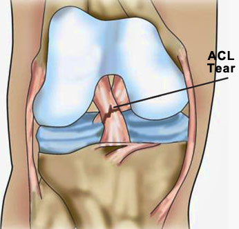 ACL Tear