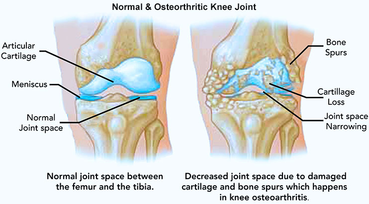 Normal & Osteoarthritic Knee Joint