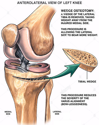 Knee Osteotomy - Dr. (Prof.) Anil Arora