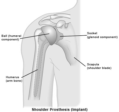 Shoulder Prosthesis